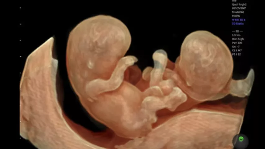 Twins seen in 3D fetal ultrasound. Image from GE Healthcare. Baby ultrasound images of twins. Foetus ultrasound.