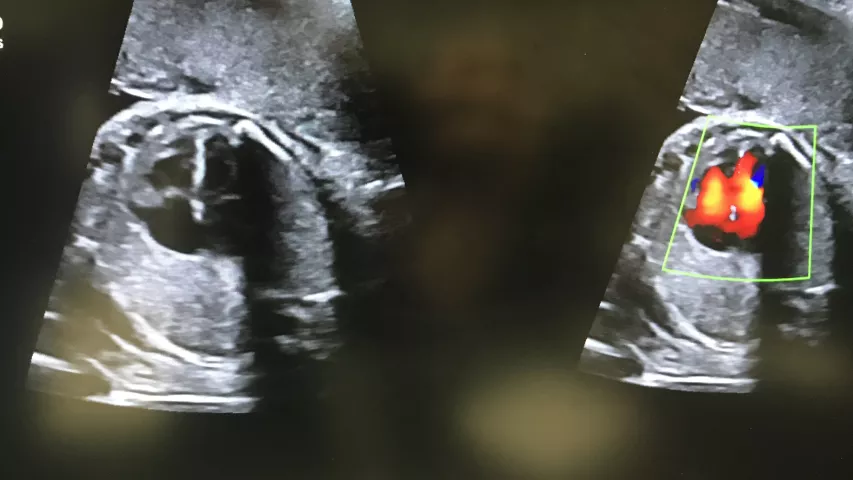 Middle cerebral artery blood flow assessment in the fetal brain using to assess blood flow and fetal hypoxemia. The white outline in the images is the fetal skull. Image courtesy of Alpinion