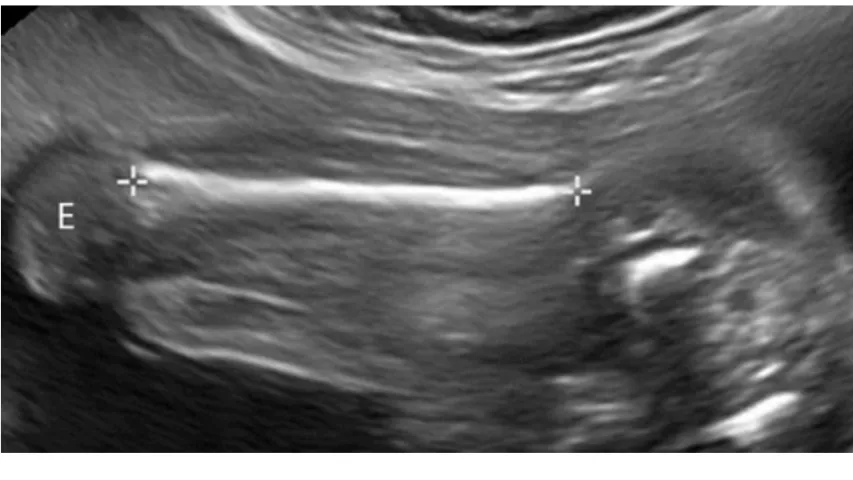 Ultrasound of a femur length measurement in a fetus at 24 weeks gestation. It shows the the epiphysis (E), the end part of the bone that initially grows separately from the shaft, without internal calcification. Bones in the fetus and babies ossifies into solid bone over time, allowing the bones to grow more rapidly. Image courtesy of RSNA. Baby ultrasound medical imaging. Baby leg on ultrasound.