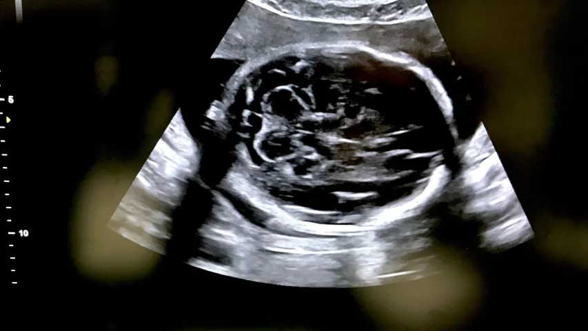 Example one of the four standard views used in prenatal ultrasound assessment of the head, imaged from the top of the skull looking down into the brain. This is the posterior fossa or transcerebellar view. It is an axial image of a fetus at about 18 weeks gestation at the level of the thalamus or midbrain. Fetal imaging. Example of a baby brain ultrasound.