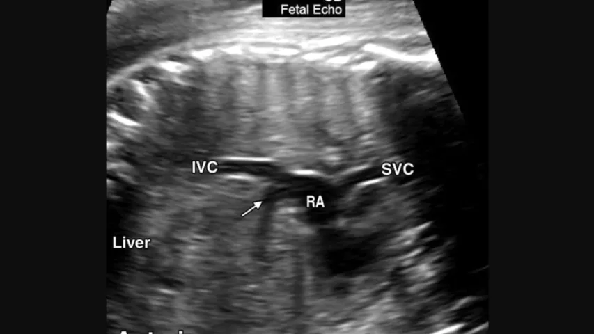 Fetal ultrasound evaluation of the vena cava connection into the right atrium of the heart to check for congenital heart abnormalities that merit referral for further evaluation. A similar evaluation will be performed on the aortic outflow tract of the heart to ensure there is normal anatomy. Image courtesy of RSNA. Baby ultrasound, fetal ultrasound images.