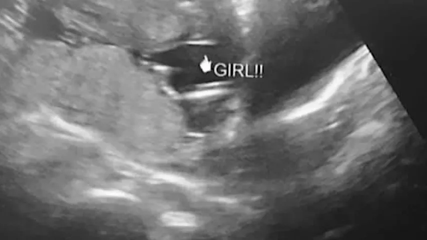 As a fetus develops, sonographers can identify the sex on ultrasound. This is an an example of the "hamburger" sign of the vagina, which looks like the two buns of a hamburger or an equal sign. Males are identified by the "turtle" sign, where the genitalia look like a small turtle, or a turtle's head poking out.  How to determine sex in fetal ultrasound. It's a girl! Baby ultrasound. Baby girl ultrasound.