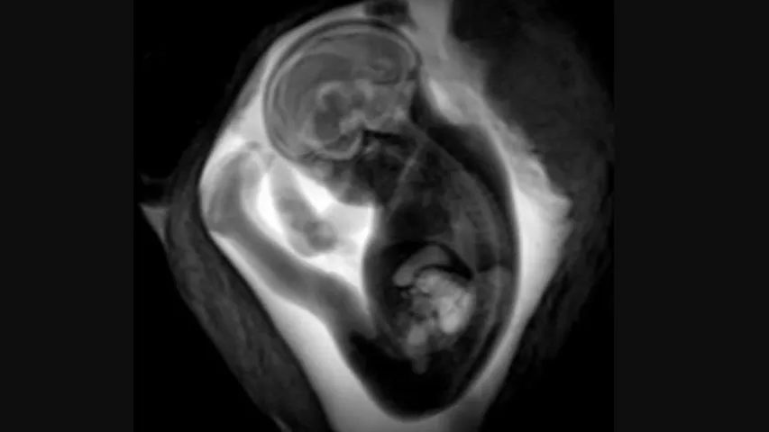 MRI of a fetus inside the mother. Image courtesy of RSNA. Fetal, baby imaging. Example of a baby MRI.