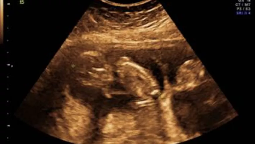 Twin pregnancy, where the head of the second fetus can be seen on the right side and the rest of its body outside the imaging plane. Image courtesy of the Department of Global Health, University of Washington #babyimages #fetalimaging #Fetalultrasound Twin baby ultrasound image. Foetus ultrasound.