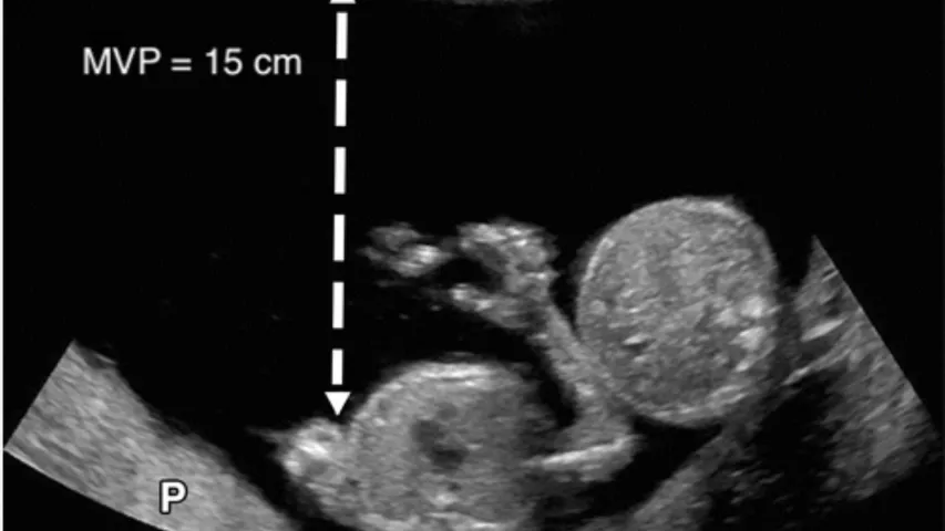 Twins on fetal ultrasound. Visible are the two heads and one of them has their arm outstretched. Image courtesy of RSNA. Twin baby ultrasound.