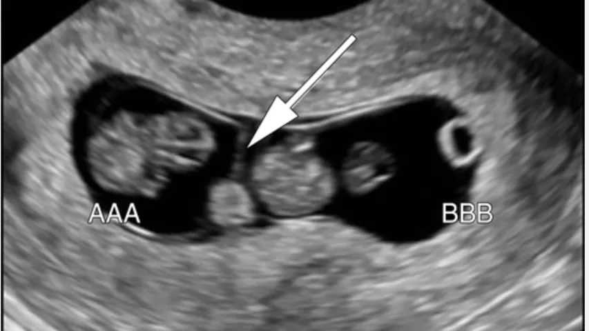 Twins on fetal ultrasound. The arrow points to the line showing the separate of the amniotic sacs. Image courtesy of RSNA. Twins baby ultrasound.
