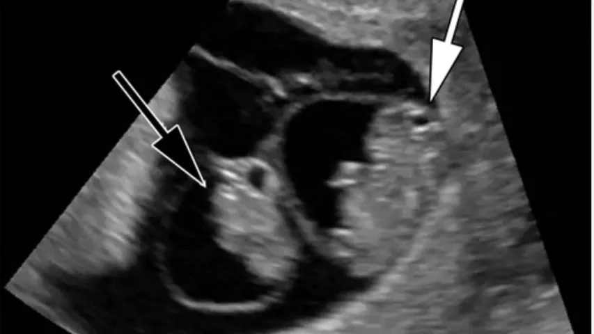 Twins on fetal ultrasound in first trimester. Visible are the separate amniotic sacs, each with an embryo inside. Image courtesy of RSNA