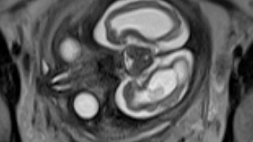 MRI of a fetus infected with zika virus microcephaly, which causes a smaller head circumference measurement than what is normal. Image from a zika patient in Brazil, which was at the epicenter of the mosquito-borne zika virus outbreak. Image courtesy of RSNA