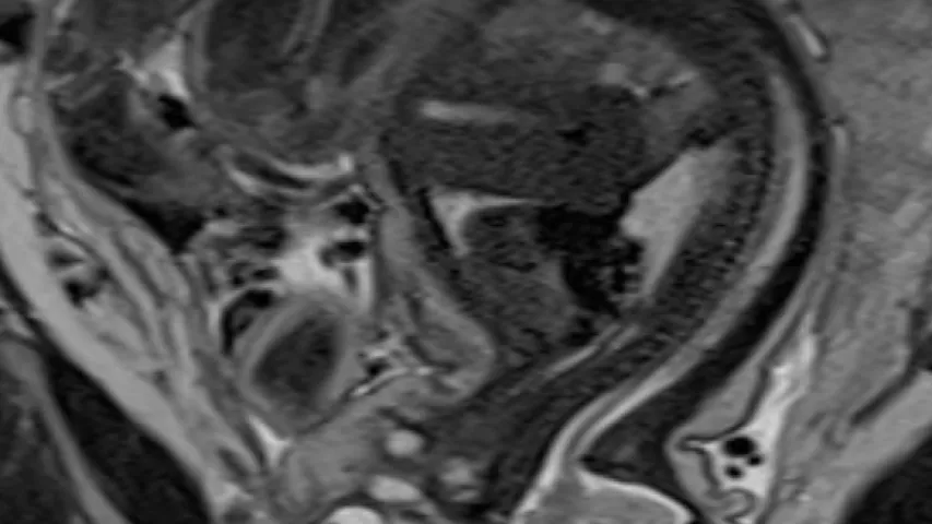 MRI of a fetus infected with zika virus microcephaly, which causes a smaller head circumference measurement than what is normal. Image from a zika patient in Brazil, which was the epicenter of the mosquito-borne zika virus outbreak. Image courtesy of RSNA. Baby with Zika Virus on MRI.