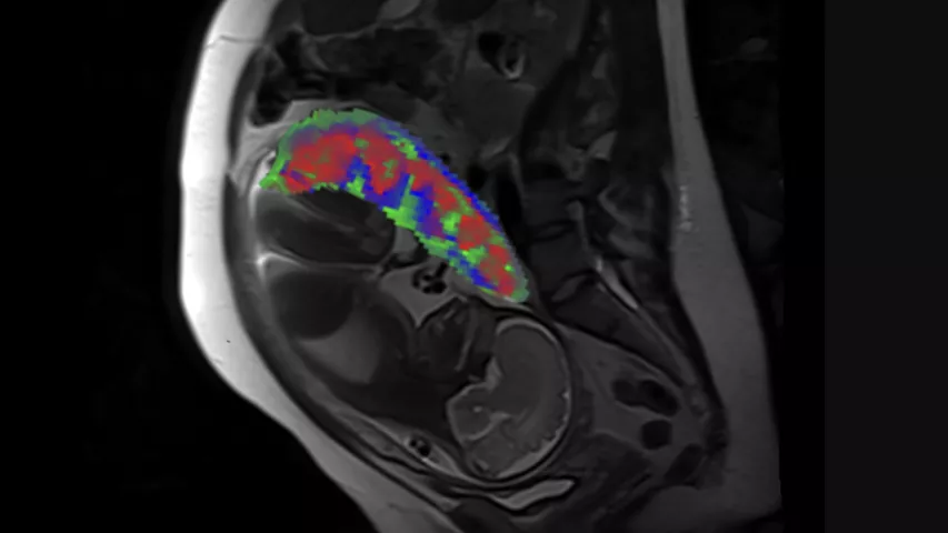 MRI scan showing the fetus and placental compartments—intervillous space (red), placental vessels (green), and placental tissue (blue). Researchers funded by the National Institutes of Health have developed a new method to process MRI scans to reveal the distinct compartments of the placenta, take measurements of oxygen levels in each region and determine if there are malformations in blood vessels (i.e., placental lesions). Obtaining this level of detail is currently not possible using standard MRI.