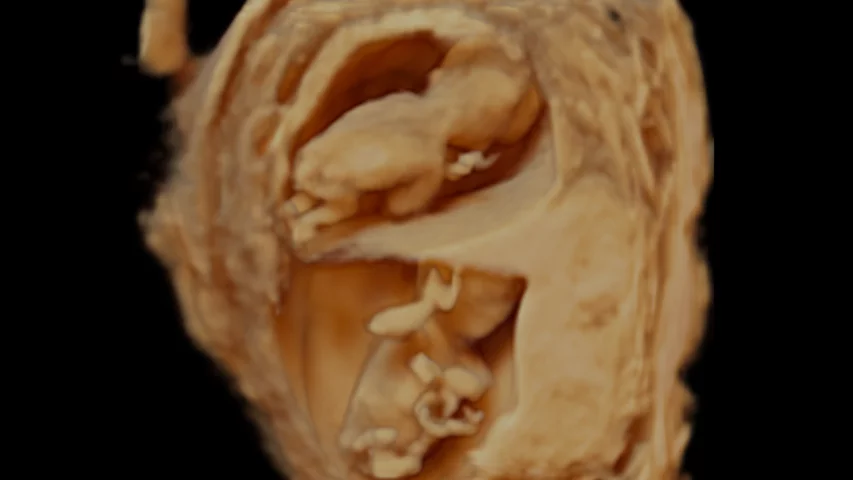 Fetal image twins Canon 3D luminance on Aplio 500 first trimester twins.
