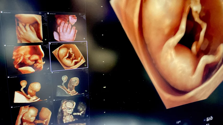 Fetal imaging 4 weeks old 3D on GE Voluson Expert 22 ultrasound at RSNA23. Photo by Dave Fornell