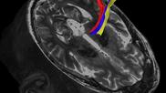 Diffusion Tractography