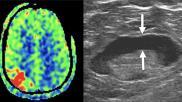 Two top stories radiology this past month was the nuclear imaging isotope shortage and an ultrasound imaging study of COVID vaccine adenopathy.