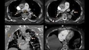 COVID causes increase risk of clotting. Example of a pulmonary embolism. CT pulmonary angiograms in a 77-year-old man with COVID-19 and a saddle embolus to pulmonary arteries (black arrow in A) extending into right and left pulmonary arteries (white arrows) in (A, B) axial and (C) coronal planes. Arrowheads show pulmonary changes associated with COVID-19 and possible lung infarction (black arrow in C). (D) Axial image at the level of the ventricles shows right-sided heart strain. RSNA. COVID PE