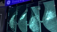 An example of contrast enhanced mammography at RSNA 2022. It shows the original mammograms to the left, and the contrast enhanced breast imaging on the right. The contrast helps enhance areas of high vascular activity, which is typical in cancer growths. Photo by Dave Fornell