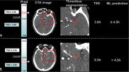 #CTA #acuteischemicstroke #AIS #radiomics