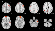 functional MRI brain scan