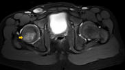 osteomyelitis on MRI