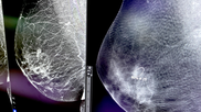 GE HealthCare Breast Cancer AI