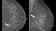 Breast arterial calcifications (BACs) identified on screening mammograms may help identify women who face a heightened risk of developing cardiovascular disease (CVD), according to a new analysis published in Clinical Imaging.