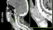 deep learning algorithm slashes radiation dose during neck CT scans