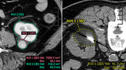 renal cryoablation volumes