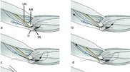 New IR procedure for cubital tunnel syndrome