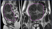 uterine fibroid embolization w/nerve block