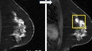 AI model spots missed breast cancers on MRI