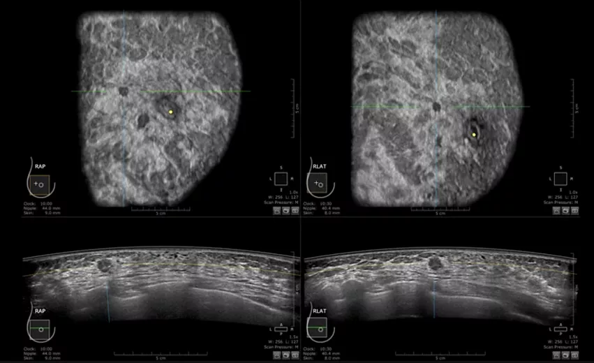An example of breast ultrasound showing a ductal carcinoma. Imaged on a GE Healthcare Invenia ABUS system.