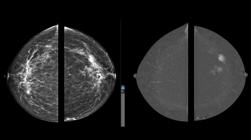 Example of contrast-enhanced mammography showing the conventional mammogram with areas of dense breast tissue on the left, and the contrast enhancement of tumors on the right. Images from a GE Senobright HD imaging system.