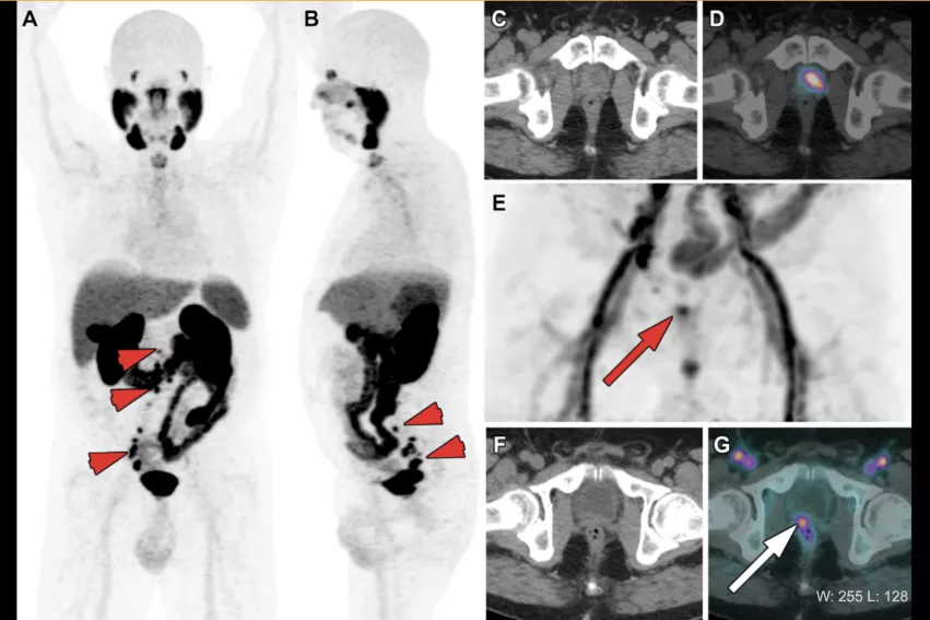 PSMA-PET example of biochemical recurrence of prostrate (PSA level = 1.1 ng/mL) in a 72-year-old patient 3 years after radical prostatectomy, chemotherapy and ADT for metastatic Gleason score 9 (5 + 4) prostate cancer. (A, B) Anterior MIP images from 68Ga-PSMA PET show multiple pelvic and retroperitoneal lymph node metastases (short arrows) and a sternal bone lesion (dashed arrow). There is also intense PSMA uptake in a large typical local recurrence on the prostate bed. RSNA photo.