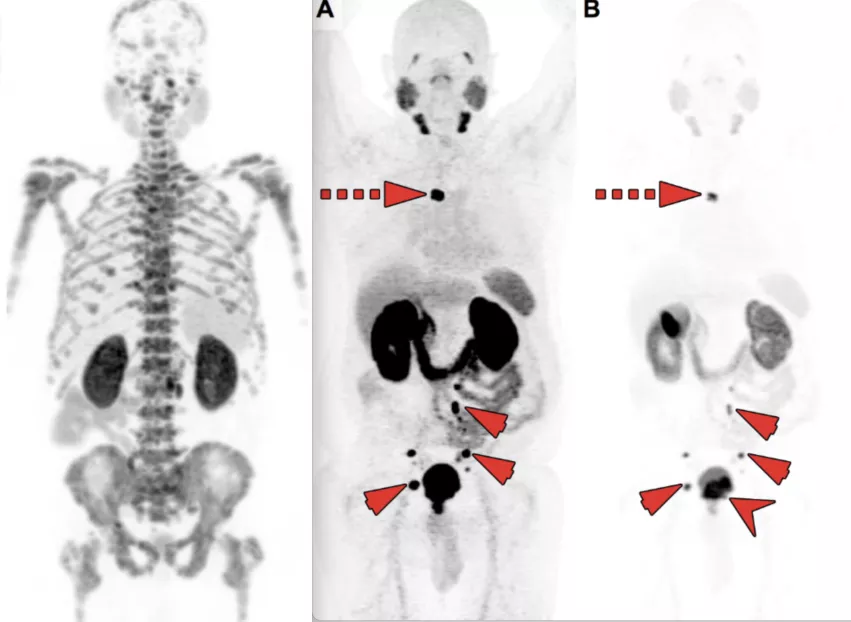 Two cases of PSMA-PET imaging showing tumors outside of the traditional pelvic bed where they are usually found in patients with chemical recurrence of prostate cancer. Several centers now widen their field of view when imaging to catch tumors that may have been missed in the past and that did not appear at all using imaging techniques other than PSMA-PET. Left image shows extensive bone metastasis. Image courtesy of SNMMI. Right image shows a chest tumor far above the typical pelvic tumors, RSNA photo.