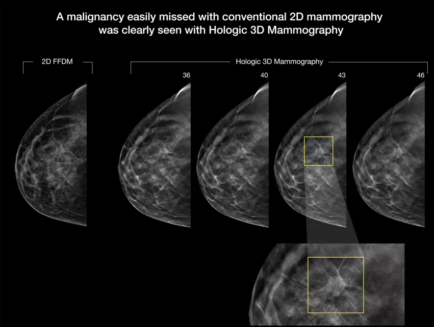 A comparison between 2D and 3D mammography on the Hologic Selenia Dimensions Mammography System. 3D tomosynthesis shoots a series of images of the breast can can be flipped through as slices of specific layers of the breast tissue, where 2D shows all the breast tissue in one image. Dense breast tissue can hide cancers, as can be seen here where one of the 3D slices found a cancer masked by dense tissue on the 2D image. Why is 3D mammography better? What is breast tomosythesis?