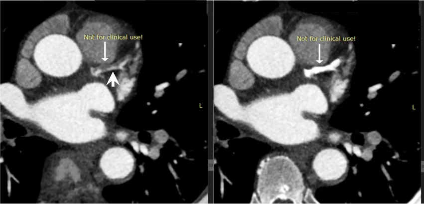 Example of a photon-counting CT scan where the heavy calcium in a coronary artery was removed using the spectral imaging properties of the technology to show the vessel lumen and underlying soft plaques. Imaging courtesy of Mayo Clinic