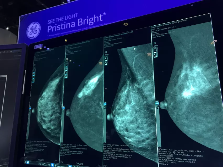 An example of contrast enhanced mammography at RSNA 2022. It shows the original mammograms to the left, and the contrast enhanced breast imaging on the right. The contrast helps enhance areas of high vascular activity, which is typical in cancer growths. Photo by Dave Fornell