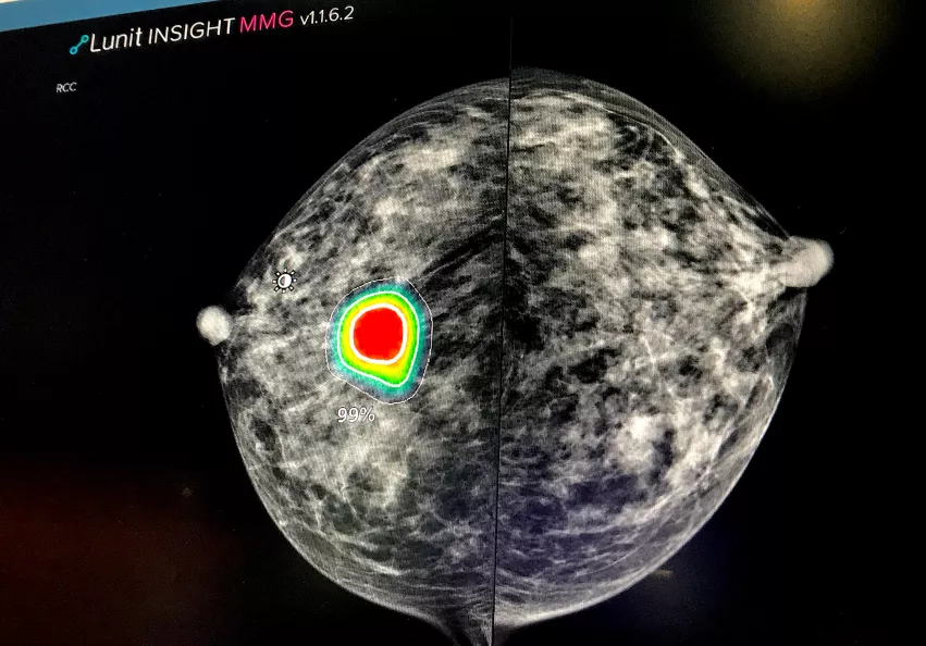 Example of AI for automated breast cancer detection, where the AI highlights an area it believes has an abnormality or patters that match cancers. This example of the Lunit AI is being show in Intelerad's enterprise imaging system as a seamlessly integrated AI tool. #RSNA22 #RSNA