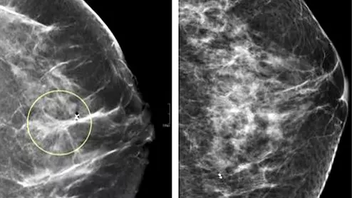 Comparison of a 2D digital mammogram and breast tomosynthesis 3D mammography from UCSF.