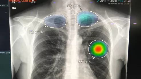 Example of AI automated detection and highlighting of critical lung findings on a chest X-ray for a possible lung cancer nodule and fibrosis. Example shown by AI vendor Lunit.