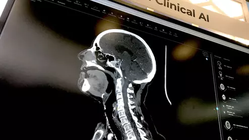 Brain imaging artificial intelligence is a primary area of concentration for AI because oif the critical nature of fast detection and treatment for patients. This is an example of the AI applications displayed by third-party advanced visualization vendor TeraRecon at RSNA 2022.