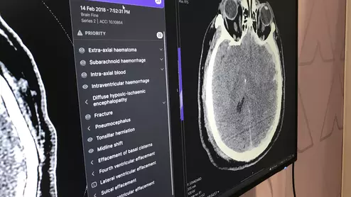 Example of data generated by an automated artificial intelligence (AI) brain CT assessment tool from Annalise.ai at RSNA 2022. What does brain imaging look like?