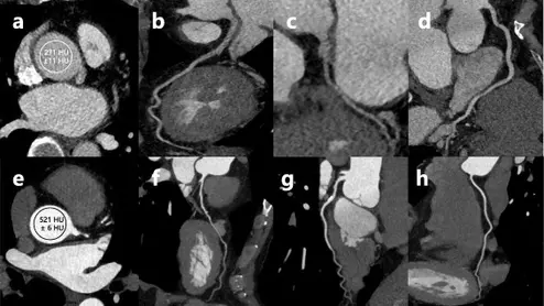 CCTA with patient-specific versus fixed post-trigger delay