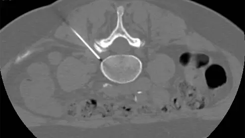 pulsed radiofrequency for sciatica