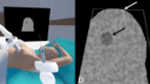 VR helps radiology trainees practice breast biopsy skills