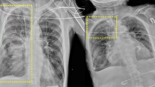 AI system detects pneumothorax on chest x-rays