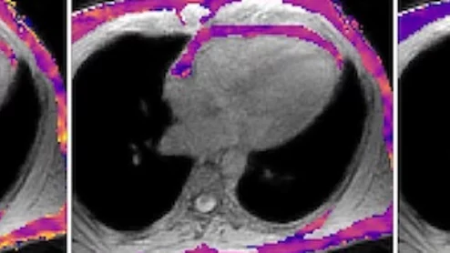 MRI technique analyzes composition of fat surrounding heart.