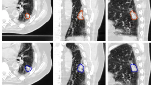 DL model identifies and segments lung tumors on CT scans.