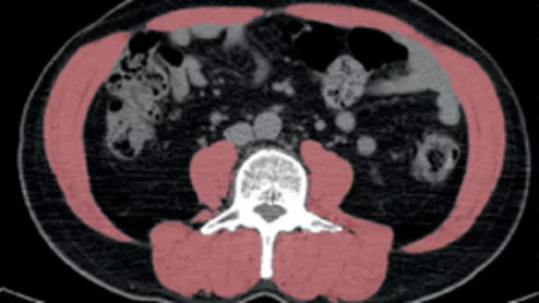 Obesity can improve lung cancer outcomes, but only if skeletal muscle quality is maintained