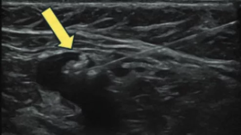 Sentinel axillary lymph node injected with tattoo ink via ultrasound guidance